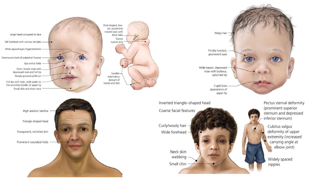 Transient Myeloproliferative Disorder (TMD), Acute Lymphoblastic Leukemia (ALL), and Juvenile Myelomonocytic Leukemia (JMML) in a Child with Noonan Syndrome: